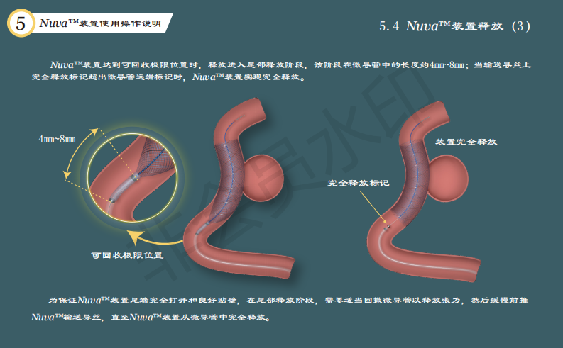 泰杰偉業(yè)公司動(dòng)脈栓塞裝置系統(tǒng)使用手冊(cè)設(shè)計(jì)圖13